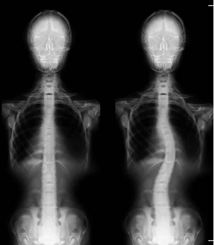 Scoliosis Treatment In Pasadena